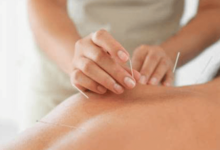 What Acupuncture Can Do for Your Health and Wellness