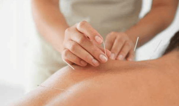 What Acupuncture Can Do for Your Health and Wellness